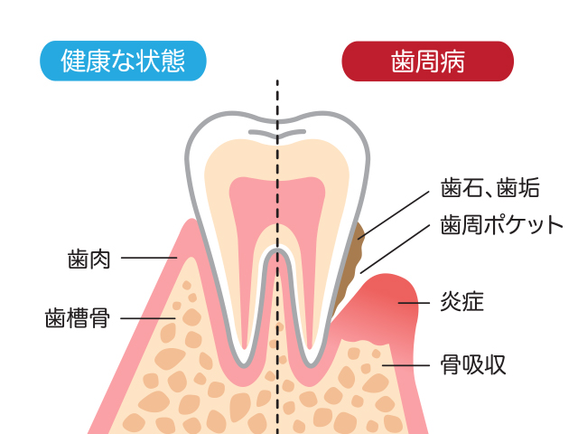 歯周炎の原因